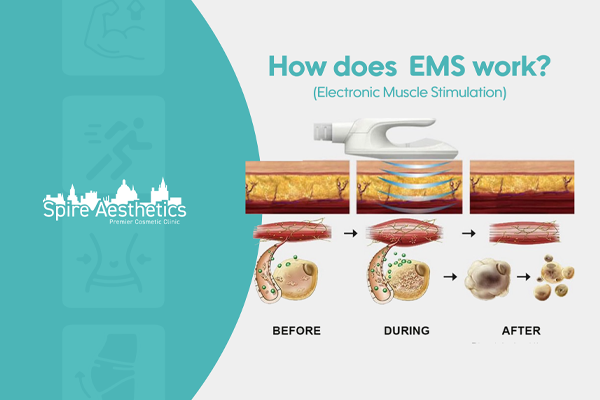 EMS treatment for post pregnancy weight loss treatment Northfield