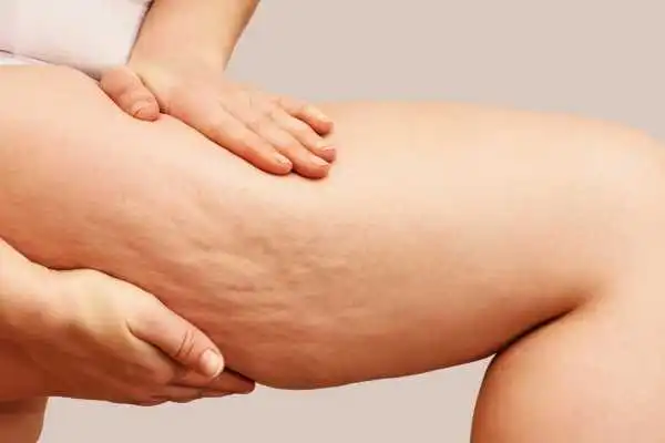 Image of woman showing leg with cellulite Northfield