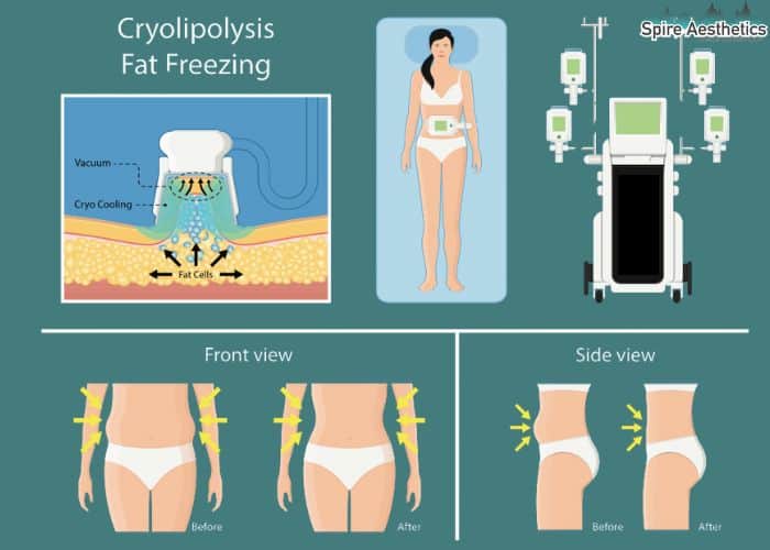Image of diet and fat freezing combined for best results for Spire Aesthetics Northfield