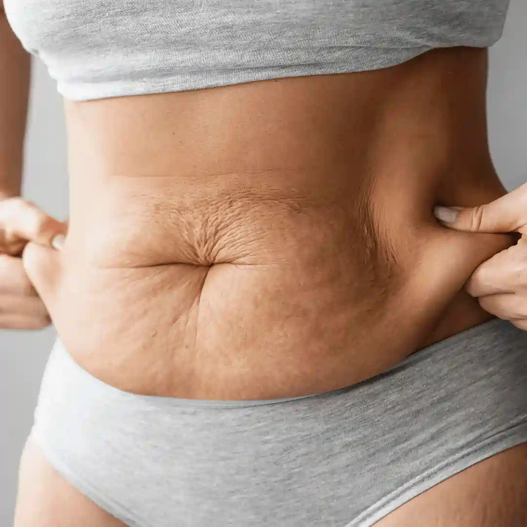 Is It Normal to Have Loose Skin After Pregnancy Northfield?